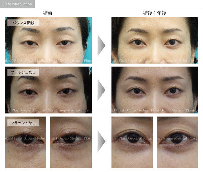 トップ100 目の下 の クマ 消え ない 世界のすべての髪型