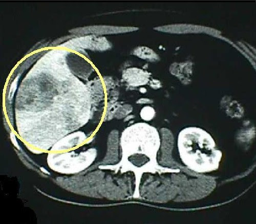 TAC del paciente Tomografía Axial Computarizada de un paciente con Fasciola hepática por ingesta de Berros