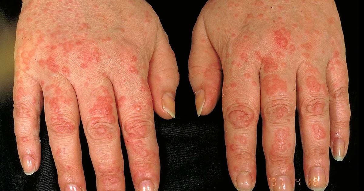 Itchy Rash On Hands And Feet / Itchy Red Or Purple Bumps