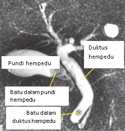 Ubat Batu Karang Dalam Hempedu - Paling G