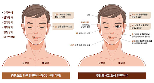 좋은 치료를 제공하는 안면 마비 병원을 찾기 위한 3가지 팁