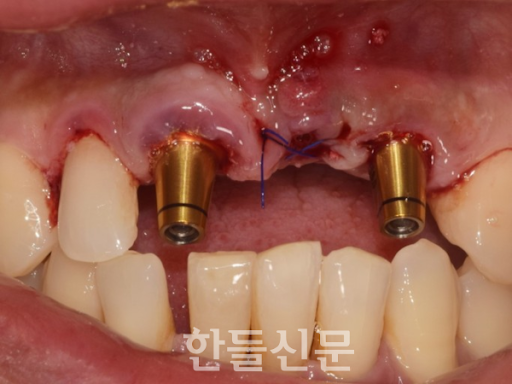 임플란트 수술 후 통증과 관리에 대하여