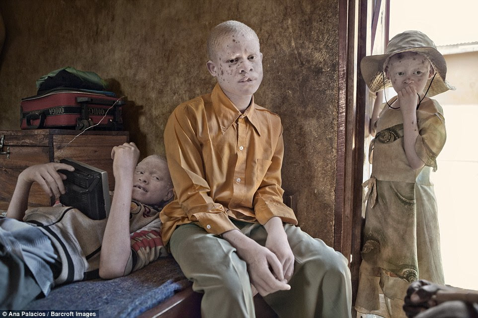 The Tanzanian Albinism Society has an estimated 8,000 registered people with albinism, but they estimate that Tanzania has a much larger population of albino people who are either unaware of the charity's work or choose to stay in hiding