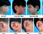 Se producen orejas 3D en China y se implantan en 5 niños