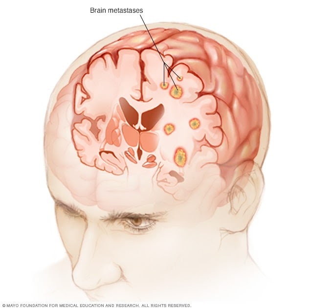 kidney-cancer-metastasis-to-brain-prognosis-cancerwalls