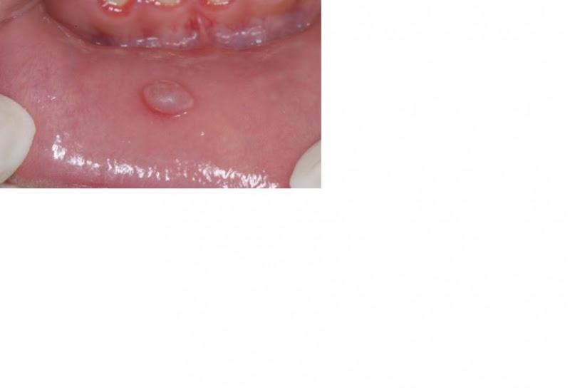 papilloma virus in bocca immagini