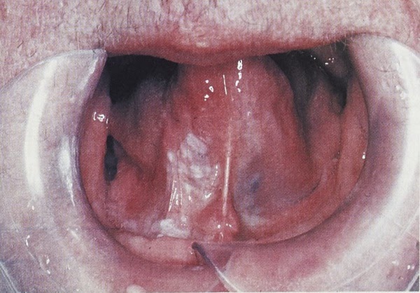 Cancer Under Tongue