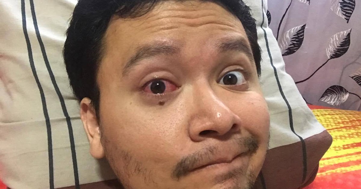 Ubat Titis Sakit Mata Contoh O