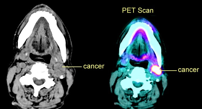 Normal Ct Scan Of Neck Lymph Nodes