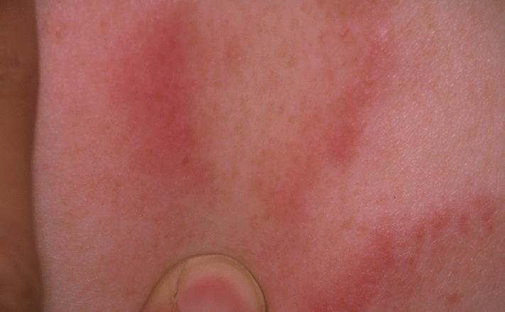 Can Stress Cause Hives And Swelling The Way To Treat Hives With
