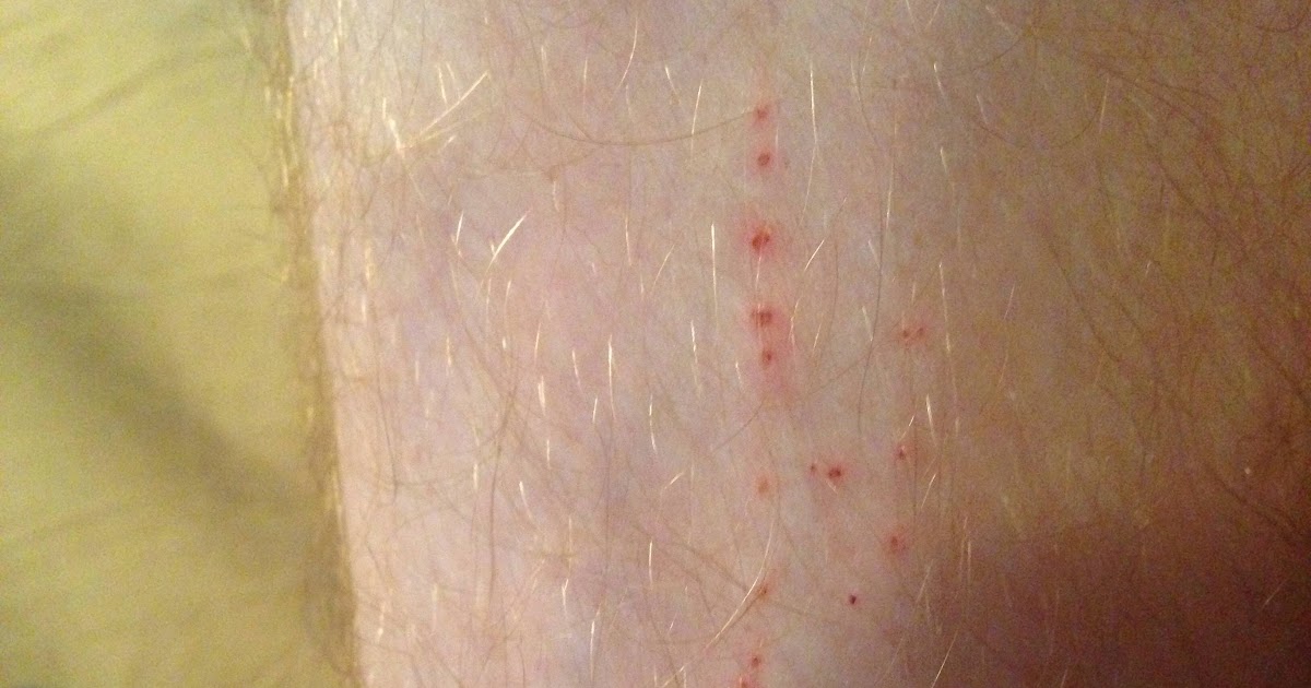 Bed Bug Bites Straight Line Moreoo