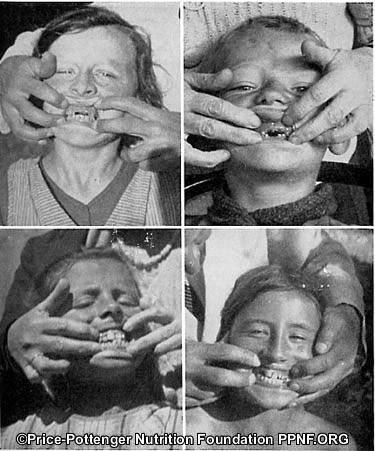 Modernized Swiss, Rampant Tooth Decay, Weston Price