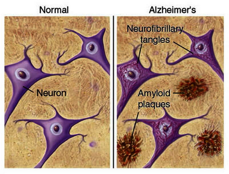 placas-y-neuronas