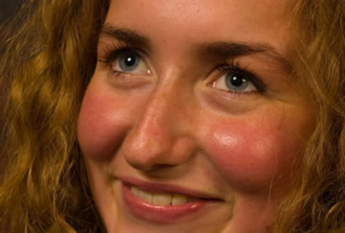 briandbradyy Pickel Im Gesicht Schwangerschaft