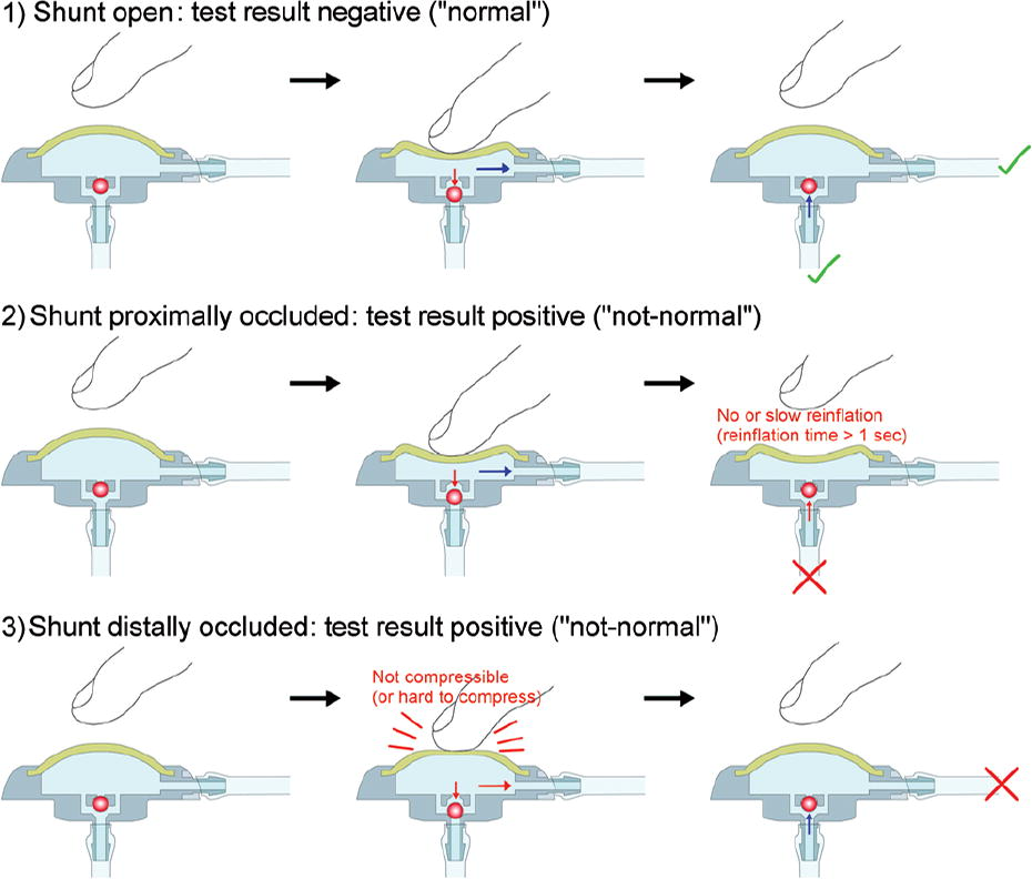 An improved reservoir for the flushing test to diagnose shunt insufficiency  in: Neurosurgical Focus Volume 41 Issue 3 (2016) Journals