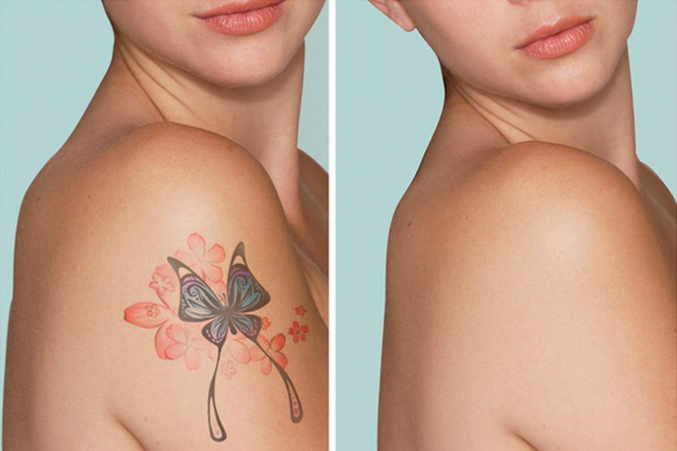 Можно ли свести татуировку без следа