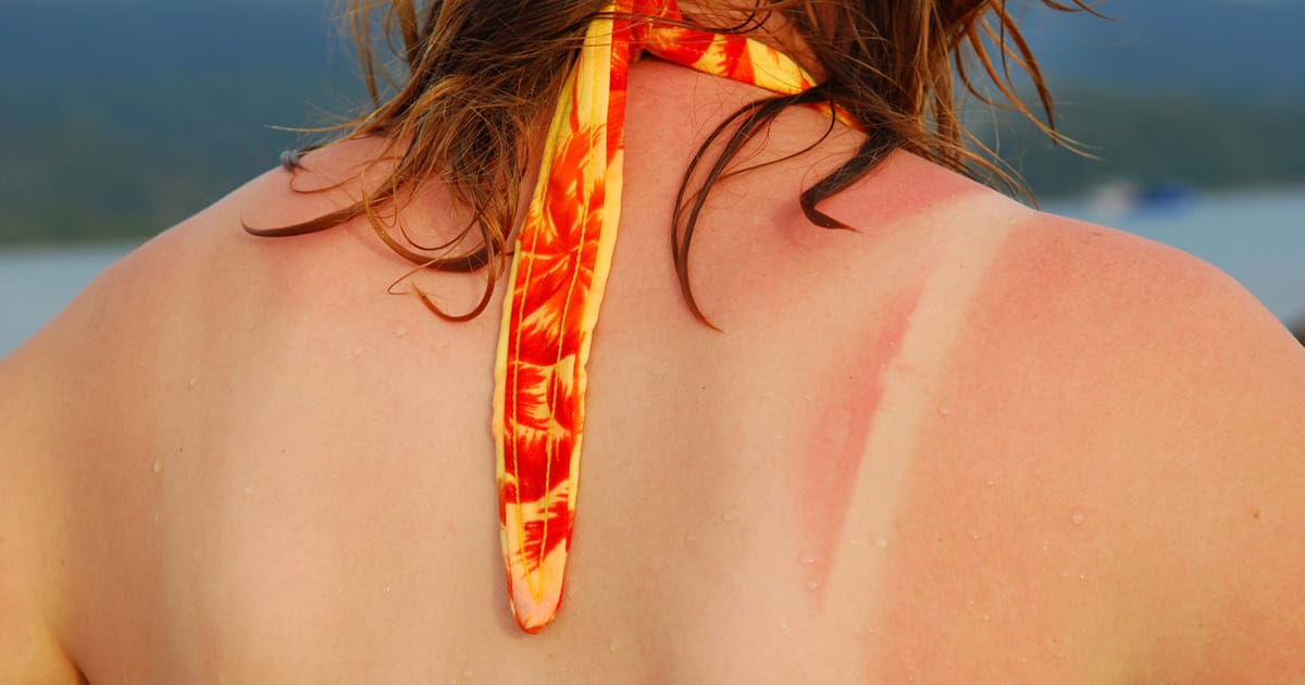 Sunburn on woman's back