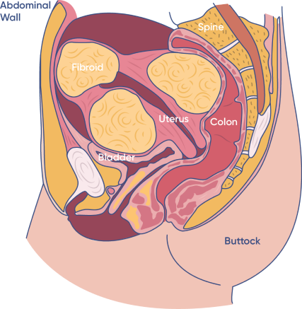 Fibroids