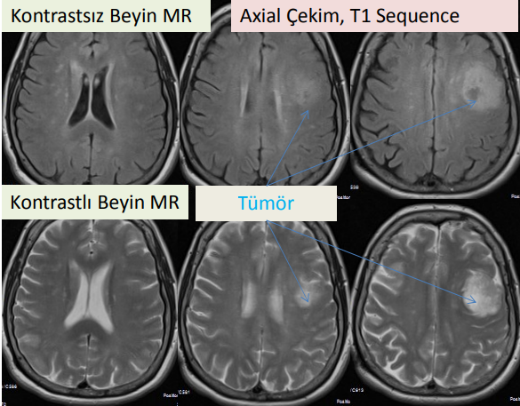 Beyin Tümörleri (Menenjiyomlar)