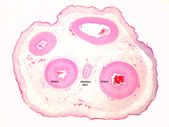 The urial umbilical cord surface has many plaques of squamous metaplasia (verrucae). The allantoic duct is in the center. Note numerous small vessels