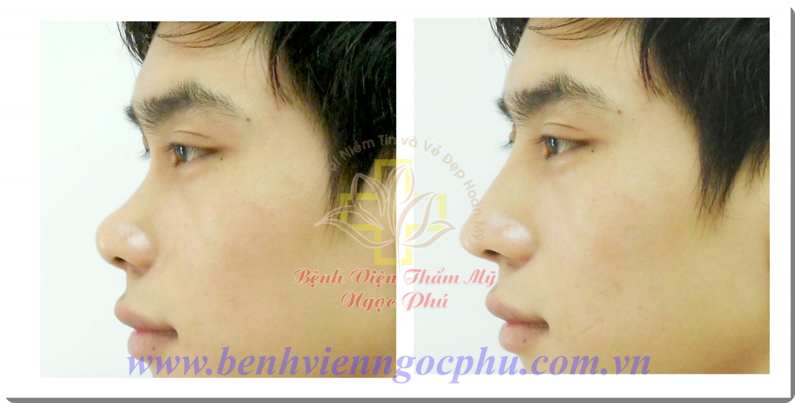 khách hàng không còn phải tốn quá nhiều chi phí, thời gian mà vẫn áp dụng được công nghệ nâng mũi Hàn Quốc với bác sĩ Hàn Quốc vô cùng dễ dàng. 