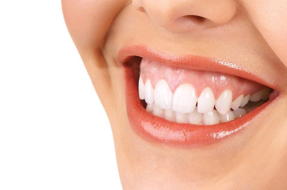 Bọc răng sứ chữa cười hở lợi có hiệu quả không?