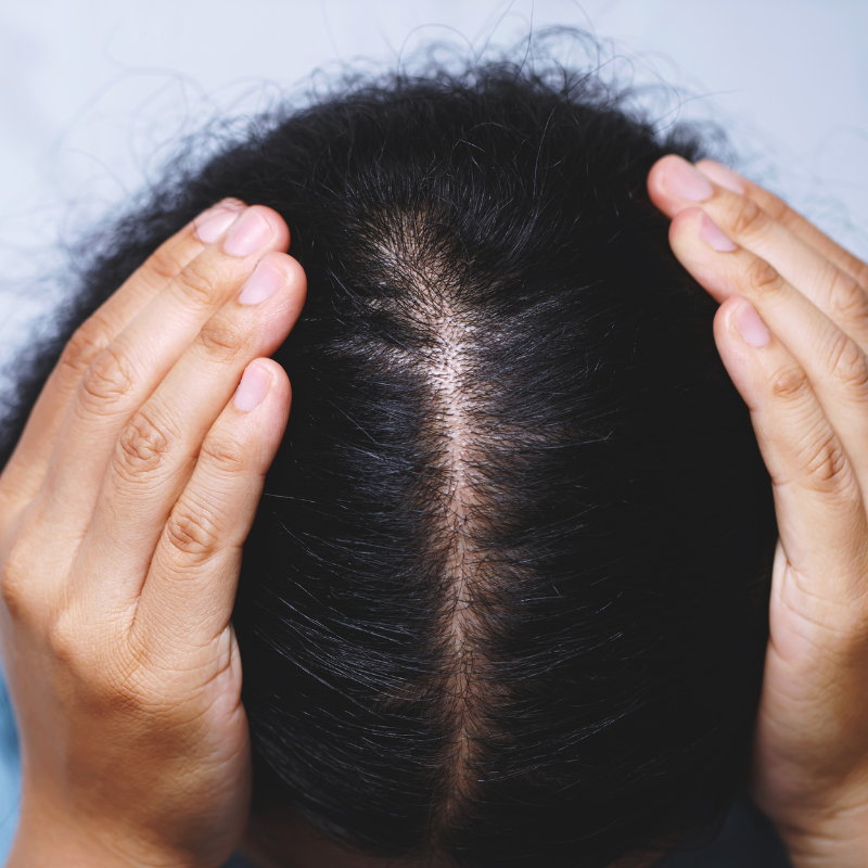  female pattern baldness, thinning occurs on the top and crown of the head. 