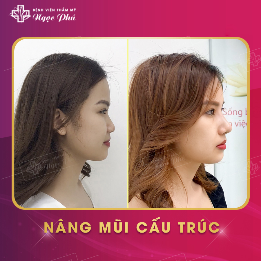 Khách hàng thực tế nâng mũi tại Thẩm Mỹ Việt Nam