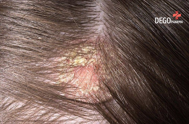  Dấu hiệu vảy nến da đầu - Xuất hiện các mảng đỏ trên vùng da đầu