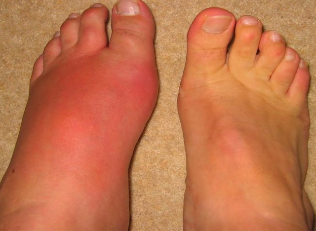 Отек и покраснение кожи на ногах из-за аллергии на холод
