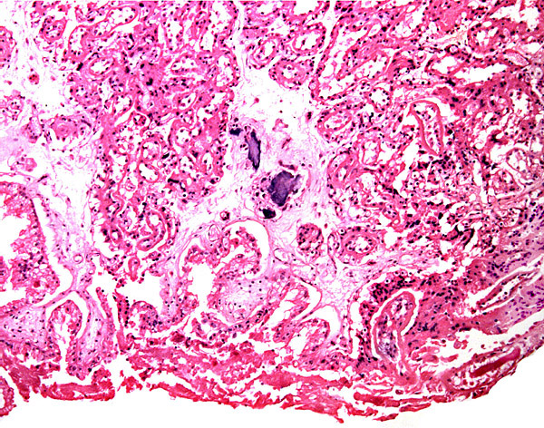 This section is from the placental floor and shows a focus of calcification in decidual remnants