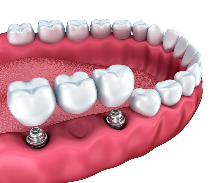 dental implants in Scarborough