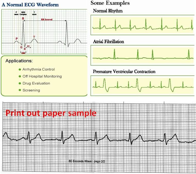 http://i694.photobucket.com/albums/vv302/MWMQAZ/ECG%20waveform_010911/ecgwaveform_010911.jpg