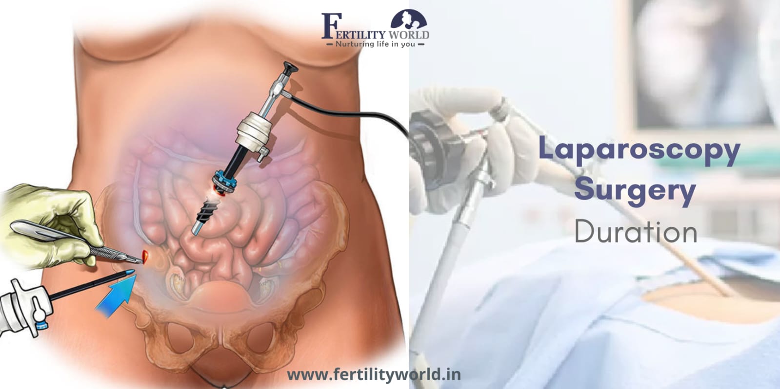 How long does a laparoscopic surgery take?