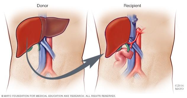 Liver transplant - Mayo Clinic