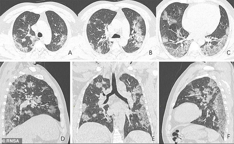 corona virüs akciğer röntgeni