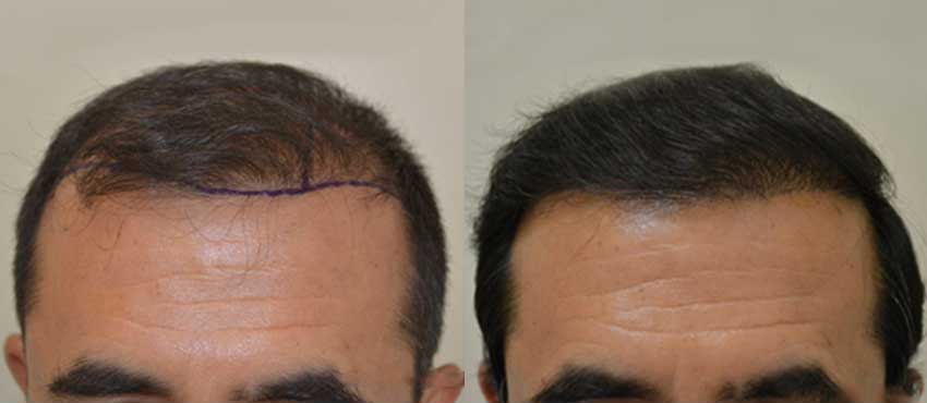 Some Tips to Select the Best Hair Transplantation in Bangalore for Hair  Problems - Healthcare Business Today