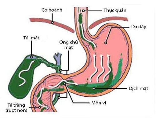 Viêm hang vị dạ dày, trào ngược dịch mật