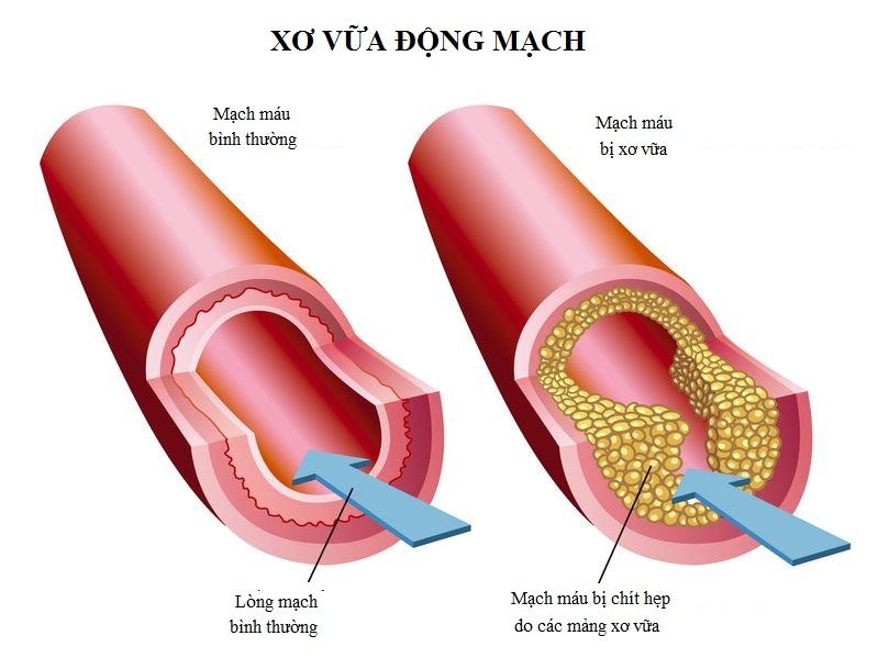 Xơ vữa động mạch là căn bệnh mang đến nhiều biến chứng nguy hiểm cho sức khỏe. 