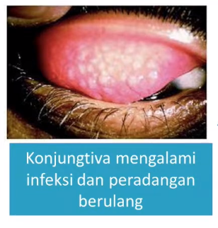 konjungtiva meraang akibat trachoma