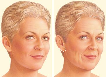 F:\aura\webpage\COSMETIC SURGERIES\FACE AND NECK CONTOURING\facelift-surgery-limited-incision.jpg