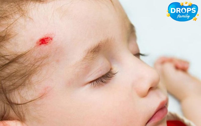 Chấn thương sọ não: xuất huyết não gây thiếu máu cấp tính ở trẻ em