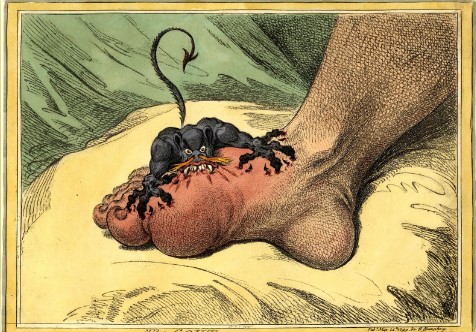 Imagem do artista James Gillray, de 1799.  Quadro clínico da gota