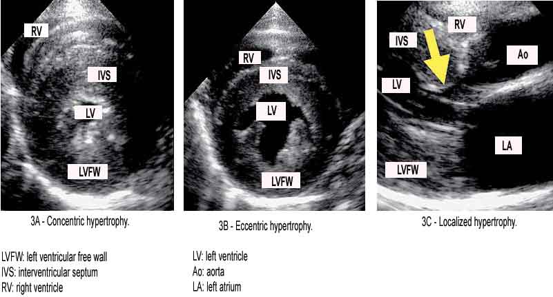 The three main types of left ventricular remodeling associated with systemic arterial hypertension in cats