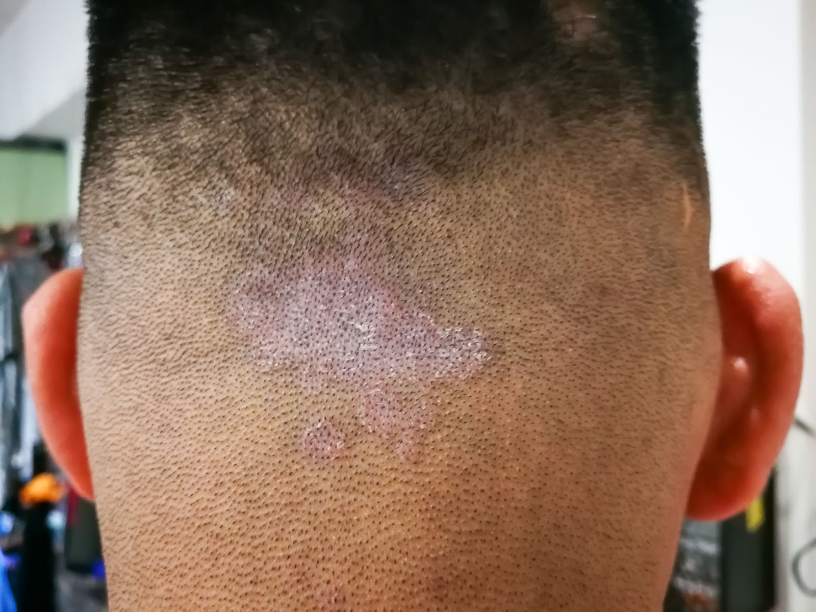 Homem com pitiríase capilar
