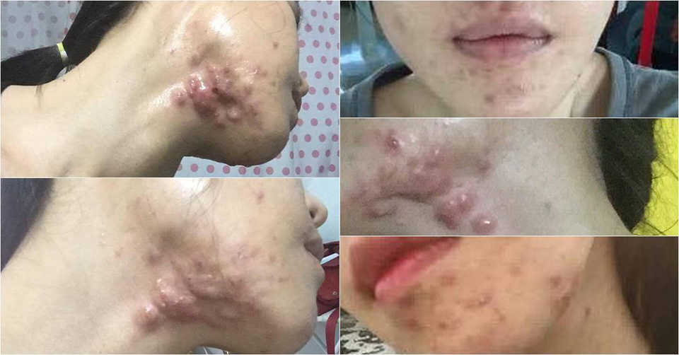 Berof Skincare. Acne Treatment Lahore