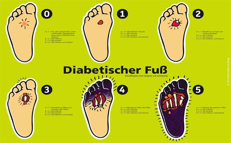 Universitätsklinikum des Saarlandes - Diabetisches Fußsyndrom