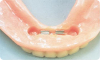 implant