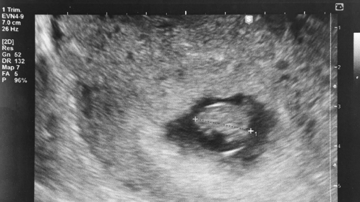 7-week ultrasound