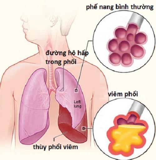 Kết quả hình ảnh cho phổi khi viêm